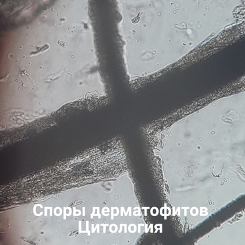 Вопрос дерматологу: ЛИШАЙ