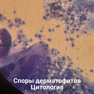 Вопрос дерматологу: ЛИШАЙ