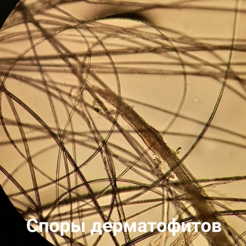 Вопрос дерматологу: ЛИШАЙ