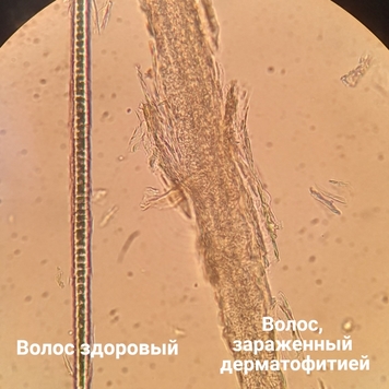 Вопрос дерматологу: ЛИШАЙ