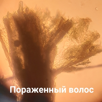 Вопрос дерматологу: ЛИШАЙ